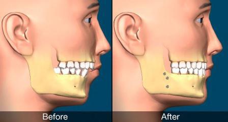 ортогнатическая хирургия до и после
