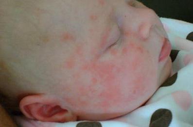 аллергия у ребенка на бета лактоглобулин
