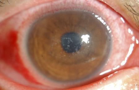вирусный кератит глаза