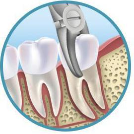 удаление кисты на зубе