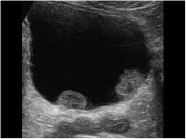 Рак мочевого фото пузыря на узи
