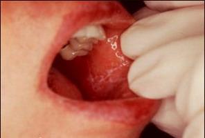 заболевание слизистой оболочки полости рта