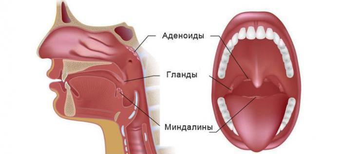 гипертрофия аденоидов 