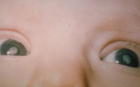 врожденная катаракта 