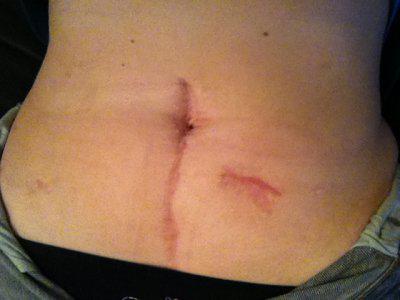 what does the suture look like after surgery