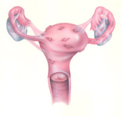 эндометриоз матки что это 