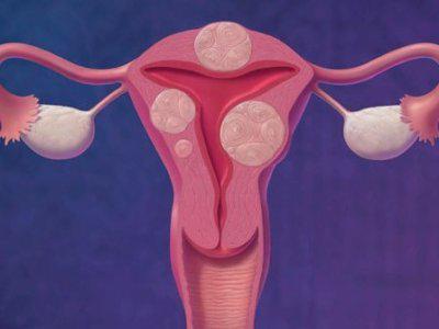 эндометриоз матки и шейки матки 
