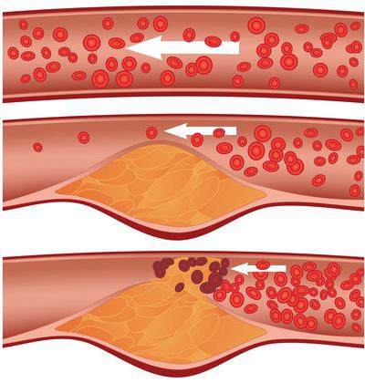 окклюзия артерии 