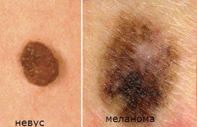 Как начинается меланома на чистой коже 28