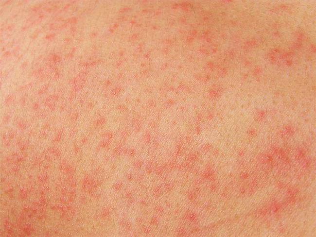 как узнать есть аллергия на лидокаин