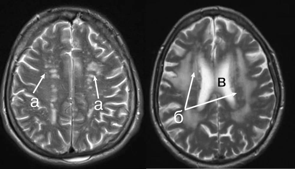 Мр картина перивентрикулярной лейкопатии