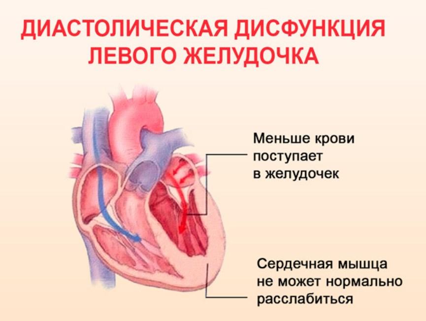 Гипертрофия левого желудочка диастолическая дисфункция. Нарушение диастолы левого желудочка. Диастолическая дисфункция левого желудочка 1 типа причина. Диастолическая дисфункция левого желудочка 2 степени. Типы дисфункции левого желудочка.