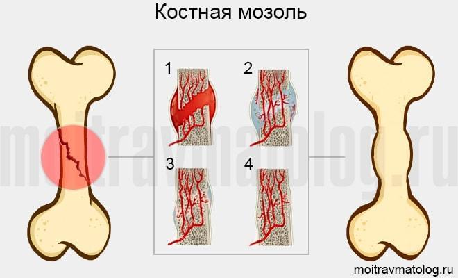 Как убрать мозоль после перелома. Костная мозоль после перелома. Эндостальная мозоль. Эндостальная костная мозоль.