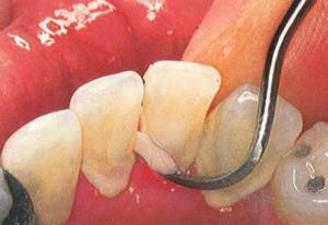 болезни зубов и дёсен