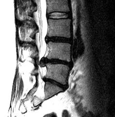 протрузия межпозвоночного диска поясничного отдела