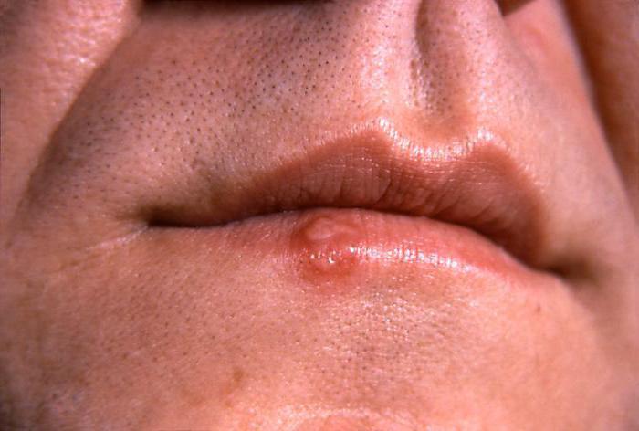 Что помогает от герпеса на губах какие препараты thumbnail