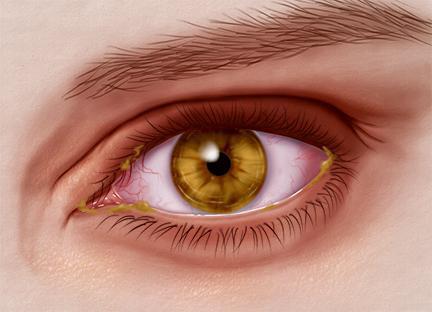 Как лечить глазной герпес в домашних условиях thumbnail