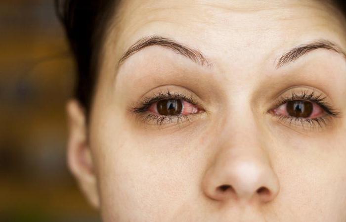 Аллергия на глазах: как лечить, эффективные способы и рекомендации