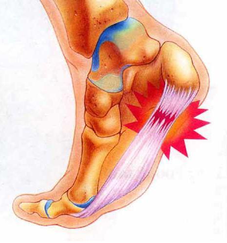 боль в ступне при наступании лечение 