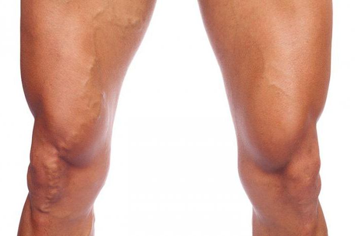 Венозное расширение вен на ногах
