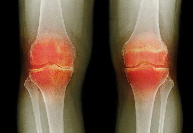 лигаментоз крестовидных связок коленного сустава лечение 