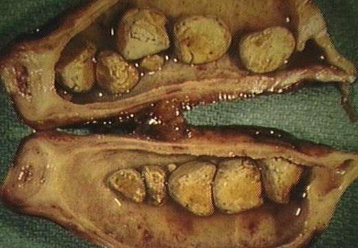 chronic cholecystitis disease