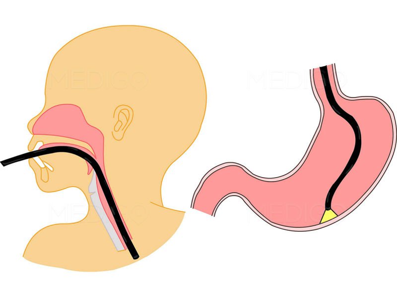 papillitis of the stomach how to treat diagnosis prevention