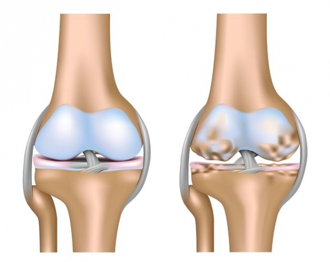 Остеоартроз сустава