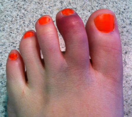 toe fracture