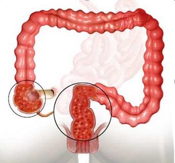 воспаление слизистой толстой кишки 