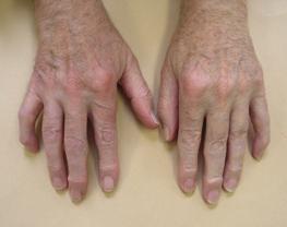 Признаки артроза кистей рук