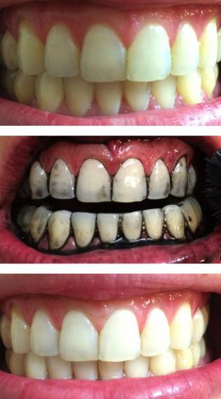 отбеливание зубов активированным углем отзывы 