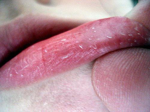 Почему сохнут и трескаются губы у женщин и при беременности. Причины и что делать. Уход и лечение кожи губ. Почему сохнут и шелушатся губы — причины и способы лечения