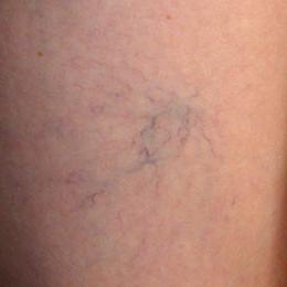 from varicose veins