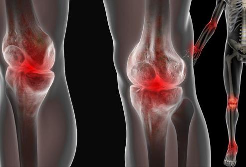 Терафлекс лечение коленного сустава thumbnail