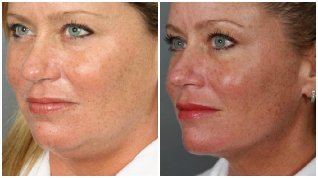 Лазерная шлифовка лица фото до и после