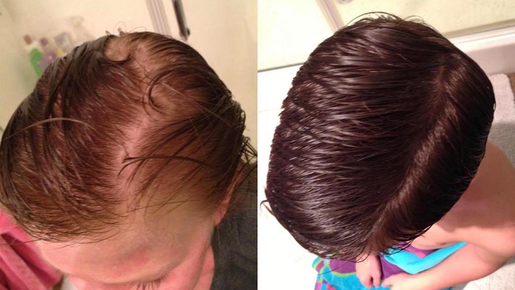 Как увеличить рост волос при выпадении в домашних условиях