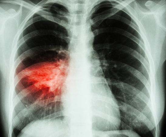 Пневмония чаще бывает односторонней