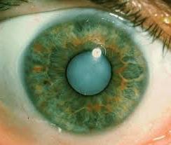 катаракта причины возникновения