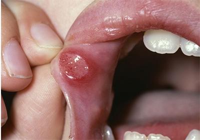 грибковые заболевания полости рта лечение