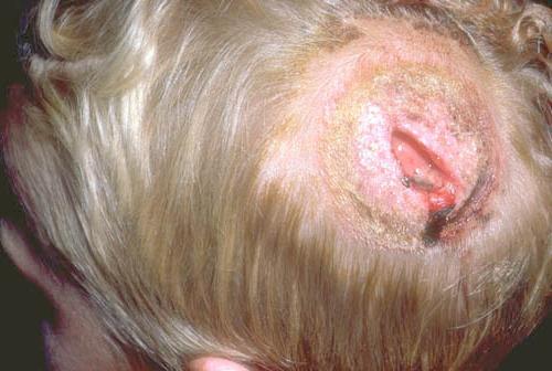 грибковые заболевания кожи головы