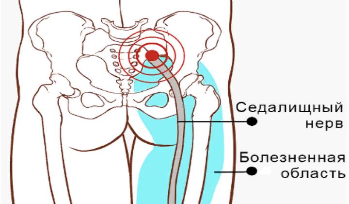 меновазин при защемлении седалищного нерва