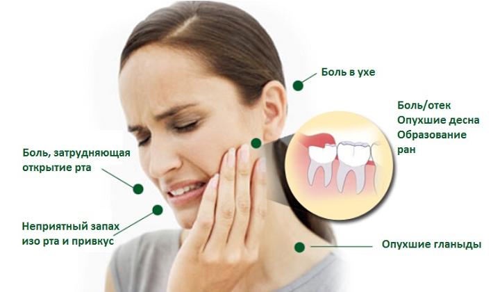 прорезается зуб мудрости