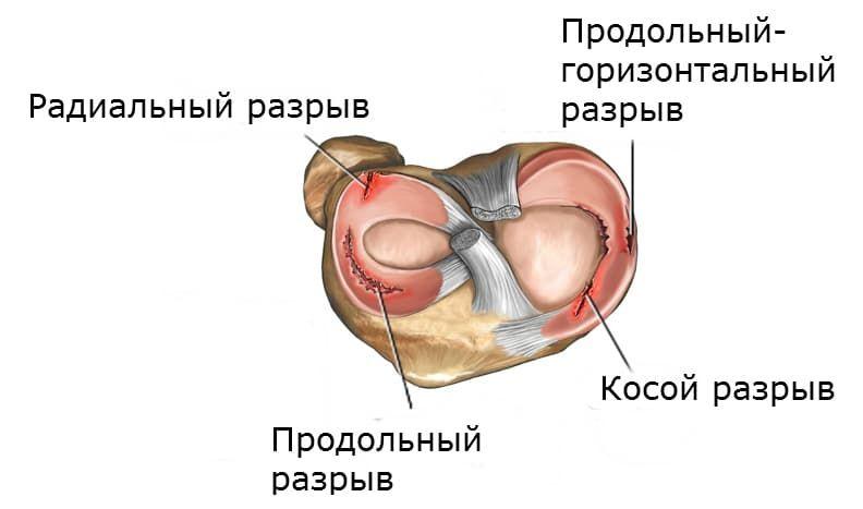 повреждения мениска коленного сустава