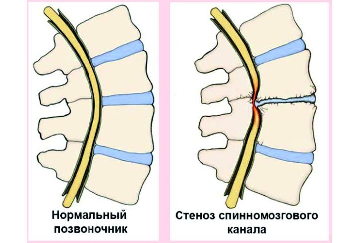 стеноз позвоночного канала