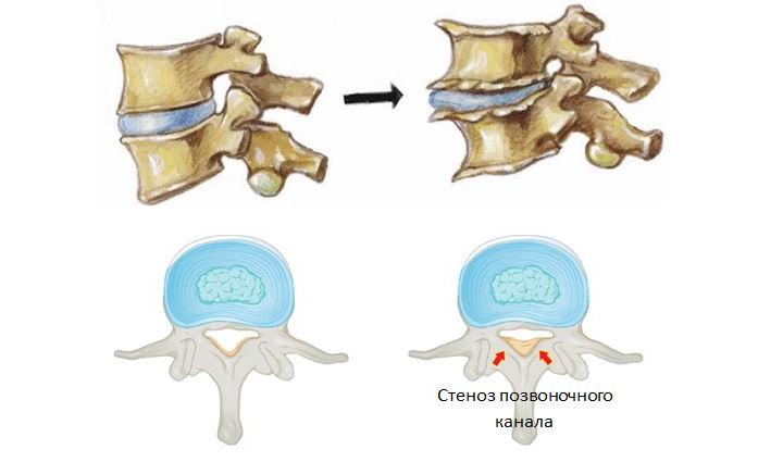 стеноз позвоночного канала