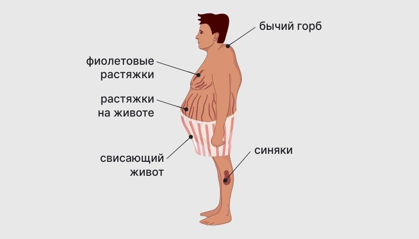 синдром иценко кушинга