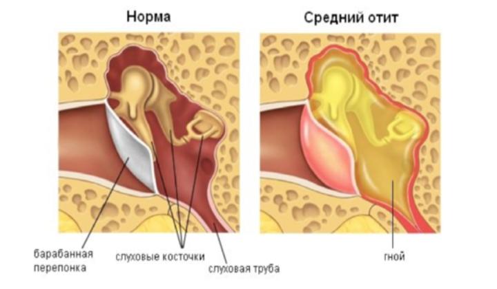 гнойный отит у ребенка