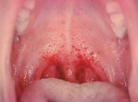 стрептококковая инфекция в горле