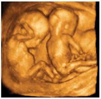 беременность монохориальная диамниотическая двойня 